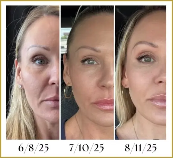 Before and after XERF skin tightening treatment results